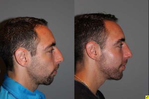 Male Rhinoplasty - 26 year old male 1 month post op following a rhinoplasty with chin implant.