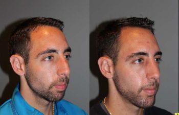 Male Rhinoplasty - 26 year old male 1 month post op following a rhinoplasty with chin implant.