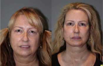 Upper Blepharoplasty & Mini Deep Plane Facelift - 54 year old female upper blepharoplasty and mini deep plane facelift 3.5 mos post op