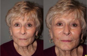 Voluma Injectable Treatment - 79 year old female after 3 syringes of voluma to nasolabial folds and cheek hollows using bruise free injectable technique.