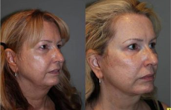 Upper Blepharoplasty & Mini Deep Plane Facelift - 54 year old female upper blepharoplasty and mini deep plane facelift 3.5 mos post op