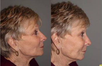Voluma Injectable Treatment - 79 year old female after 3 syringes of voluma to nasolabial folds and cheek hollows using bruise free injectable technique.