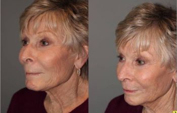 Voluma Injectable Treatment - 79 year old female after 3 syringes of voluma to nasolabial folds and cheek hollows using bruise free injectable technique.