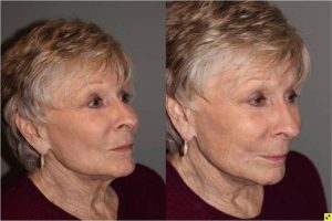 Voluma Injectable Treatment - 79 year old female after 3 syringes of voluma to nasolabial folds and cheek hollows using bruise free injectable technique.