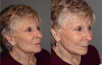 Voluma Injectable Treatment - 79 year old female after 3 syringes of voluma to nasolabial folds and cheek hollows using bruise free injectable technique.