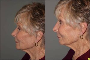 Voluma Injectable Treatment - 79 year old female after 3 syringes of voluma to nasolabial folds and cheek hollows using bruise free injectable technique.