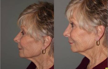 Voluma Injectable Treatment - 79 year old female after 3 syringes of voluma to nasolabial folds and cheek hollows using bruise free injectable technique.