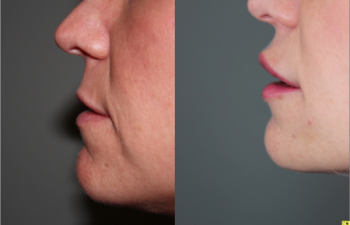 Lip augmentation with Juvederm - before and after.