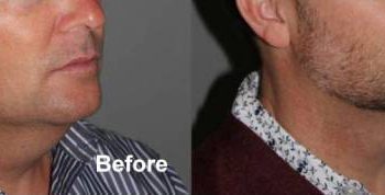 43 year old male one month after 2nd treatment