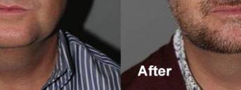 43 year old male one month after 2nd treatment