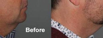 43 year old male one month after 2nd treatment