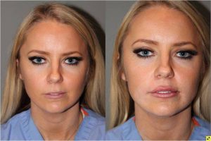 Lip Injections - 25 year old female after bruise free microcannula restylane silk lip injections.