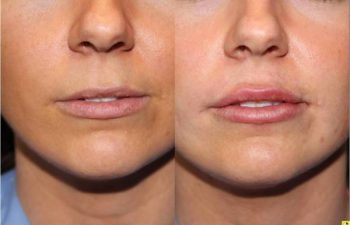 Lip Injections - 25 year old female after bruise free microcannula restylane silk lip injections.