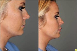 Lip Injections - 25 year old female after bruise free microcannula restylane silk lip injections.