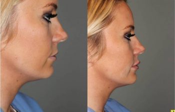 Lip Injections - 25 year old female after bruise free microcannula restylane silk lip injections.