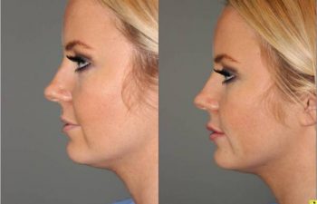 Lip Injections - 25 year old female after bruise free microcannula restylane silk lip injections.