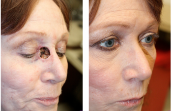 Before & After Inner canthus/nasal defect - 57 year old female with large inner canthus/nasal defect following Mohs surgery, requiring a glabellar flap reconstruction.