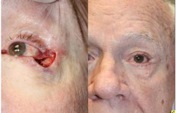 Lower eyelid Mohs defect - 79 year old male with outer, lower eyelid and lateral canthal tendon Mohs defect, 2 months following a lateral canthal tendon repair and myocutaneous tenzel flap reconstruction.