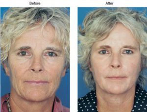 Before and After photo of a womans face after using Obagi Blue Peel