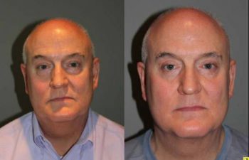 Blepharoplasty and cosmetic surgery silo before and after - 52 year old male 3 months post op from upper and lower blepharoplasty or eyelid lift.