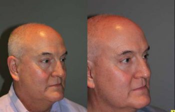 Blepharoplasty and cosmetic surgery silo before and after - 52 year old male 3 months post op from upper and lower blepharoplasty or eyelid lift.