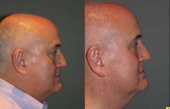 Blepharoplasty and cosmetic surgery silo before and after - 52 year old male 3 months post op from upper and lower blepharoplasty or eyelid lift.