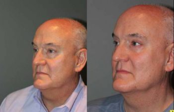 Blepharoplasty and cosmetic surgery silo before and after - 52 year old male 3 months post op from upper and lower blepharoplasty or eyelid lift.