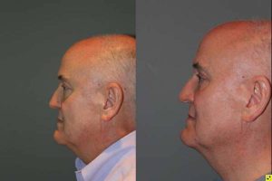 Blepharoplasty and cosmetic surgery silo before and after - 52 year old male 3 months post op from upper and lower blepharoplasty or eyelid lift.