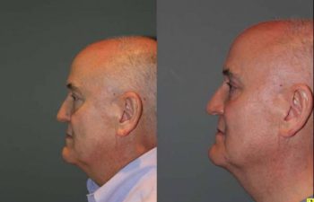 Blepharoplasty and cosmetic surgery silo before and after - 52 year old male 3 months post op from upper and lower blepharoplasty or eyelid lift.