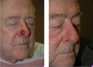 Before & After Bilobed flap reconstruction - Post-Mohs nasal skin defect requiring bilobed flap reconstruction.