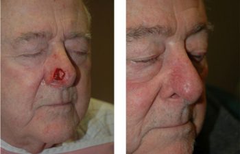 Before & After Bilobed flap reconstruction - Post-Mohs nasal skin defect requiring bilobed flap reconstruction.