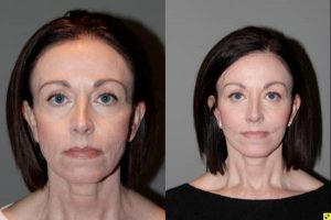 Before & After S-Lift Facelift and Lower Blepharoplasty - Correction of aging neck, jaw line and lower eyelids. 49 year old female desiring correction of her aging neck and jaw line and the bags/puffiness under her eyes. She underwent S-Lift facelift and lower eyelid blepharoplasty with fat transposition 4 months previously.