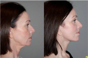Before & After S-Lift Facelift and Lower Blepharoplasty - Correction of aging neck, jaw line and lower eyelids. 49 year old female desiring correction of her aging neck and jaw line and the bags/puffiness under her eyes. She underwent S-Lift facelift and lower eyelid blepharoplasty with fat transposition 4 months previously.