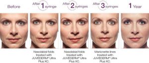 Juvederm® XC Optimal Correction - before and after 1 year.