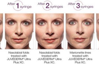 Juvederm® XC Optimal Correction - before and after 1 year.
