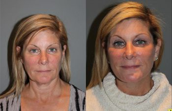 KalosLift Facelift - 51 year old female 9 months post op, following a KalosLift or an extended mini deep plane facelift