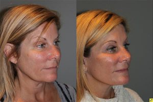 KalosLift - 51 year old female 9 months post op, following a KalosLift or an extended mini deep plane facelift