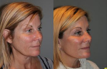 KalosLift - 51 year old female 9 months post op, following a KalosLift or an extended mini deep plane facelift