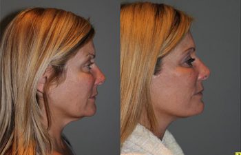 KalosLift Facelift - 51 year old female 9 months post op, following a KalosLift or an extended mini deep plane facelift