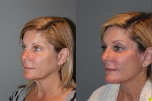 KalosLift Facelift - 51 year old female 9 months post op, following a KalosLift or an extended mini deep plane facelift