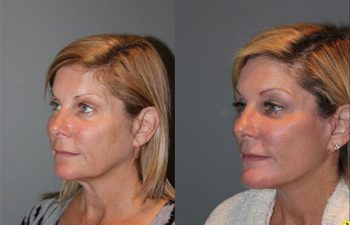 KalosLift Facelift - 51 year old female 9 months post op, following a KalosLift or an extended mini deep plane facelift