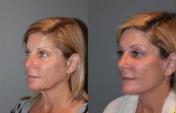 Extended Mini Deep Plane Facelift - 51 year old female 9 months post op, following a KalosLift or an extended mini deep plane facelift