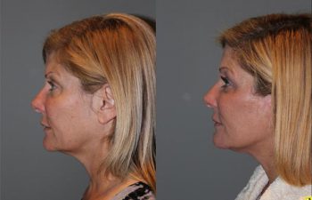 KalosLift Facelift - 51 year old female 9 months post op, following a KalosLift or an extended mini deep plane facelift