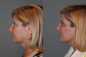 Extended Mini Deep Plane Facelift - 51 year old female 9 months post op, following a KalosLift or an extended mini deep plane facelift