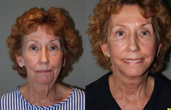 Mini Deep Plane Facelift - 61 year old female 1.5 months after Mini Deep Plane Facelift