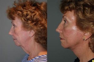 The KalosLift - 61 year old female 1.5 months after The KalosLift.