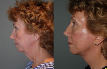 Mini Deep Plane Facelift - 61 year old female 1.5 months after Mini Deep Plane Facelift.