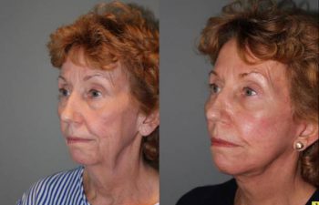 Mini Deep Plane Facelift - 61 year old female 1.5 months after Mini Deep Plane Facelift