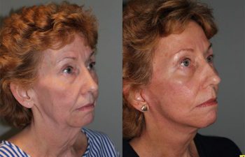 Mini Deep Plane Facelift - 61 year old female 1.5 months after Mini Deep Plane Facelift