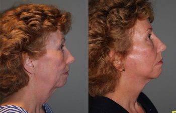 Mini Deep Plane Facelift - 61 year old female 1.5 months after Mini Deep Plane Facelift
